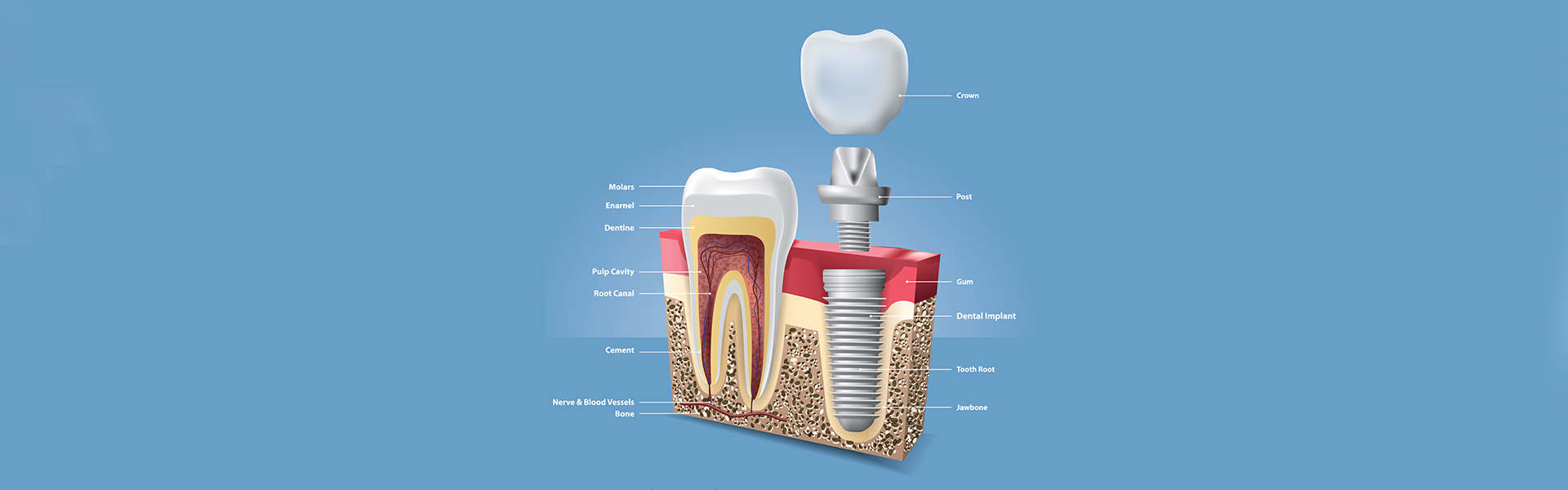 A Guide to Dental Implants: Exploring the Different Types