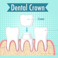 Why You Might Need a Dental Crown: Common Reasons Explained