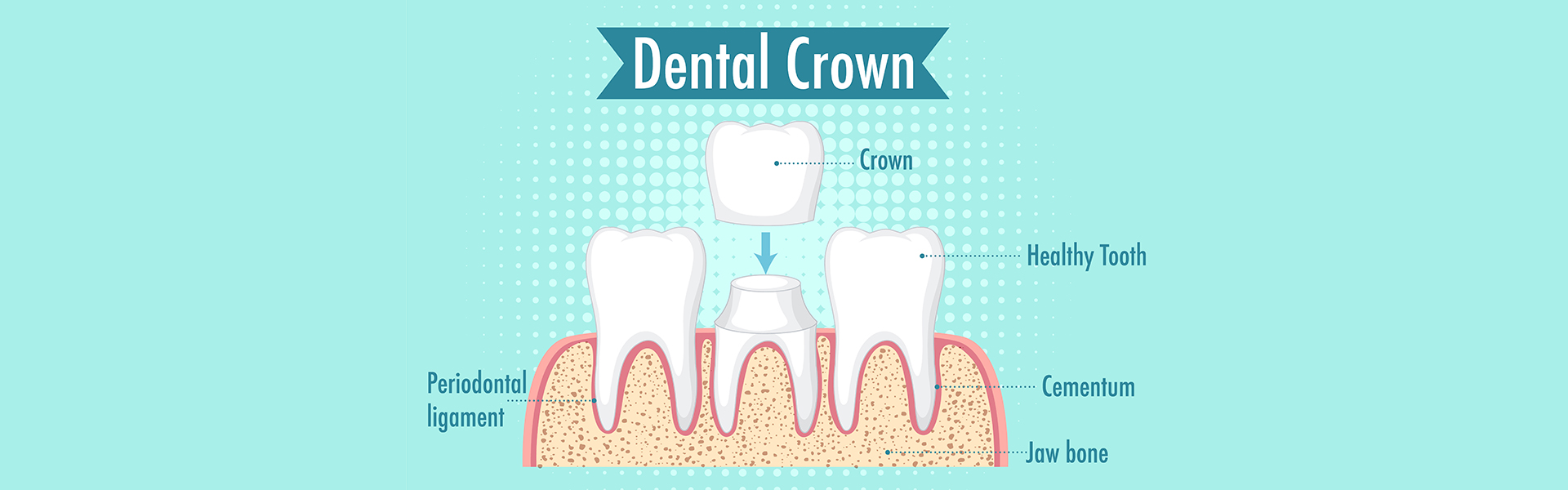 Why You Might Need a Dental Crown: Common Reasons Explained